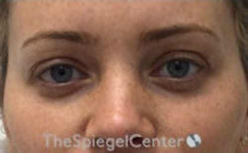 Tear Trough / Under Eye Fillers Before & After Gallery - Patient 365736 - Image 1