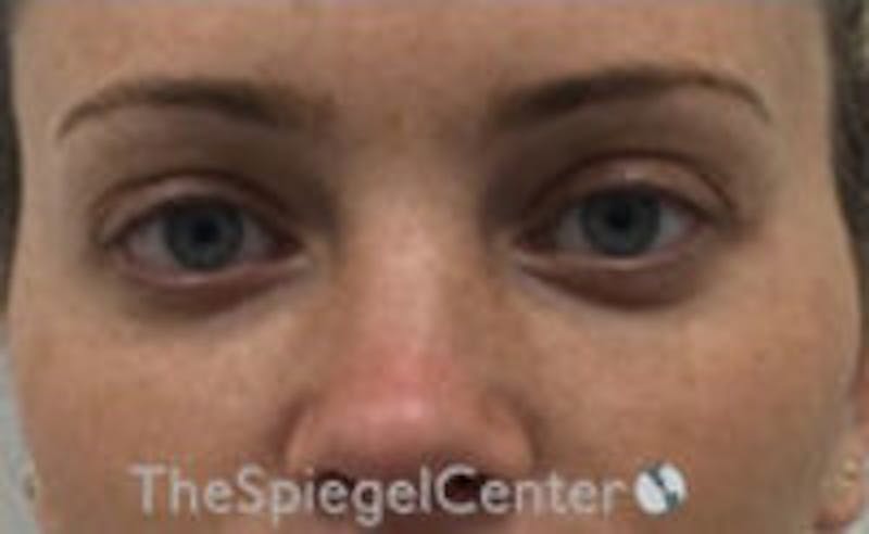 Tear Trough / Under Eye Fillers Before & After Gallery - Patient 365736 - Image 2