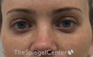 Tear Trough / Under Eye Fillers Before & After Gallery - Patient 365736 - Image 2