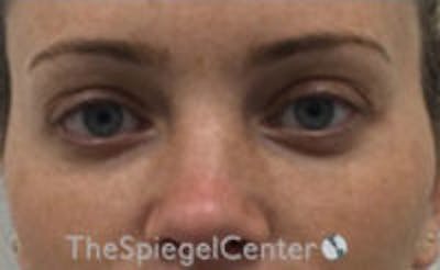 Tear Trough / Under Eye Fillers Before & After Gallery - Patient 365736 - Image 2