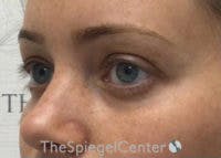 Tear Trough / Under Eye Fillers Before & After Gallery - Patient 365736 - Image 3
