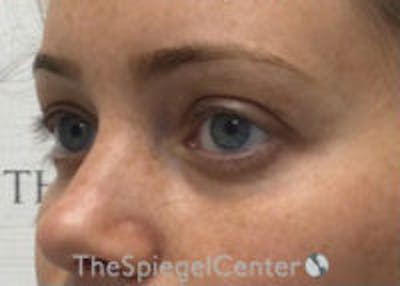 Tear Trough / Under Eye Fillers Before & After Gallery - Patient 365736 - Image 3