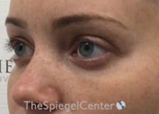 Tear Trough / Under Eye Fillers Before & After Gallery - Patient 365736 - Image 4