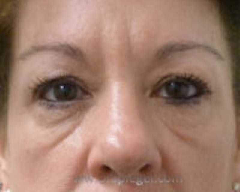 Tear Trough / Under Eye Fillers Before & After Gallery - Patient 218600 - Image 1