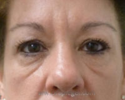 Tear Trough / Under Eye Fillers Before & After Gallery - Patient 218600 - Image 1