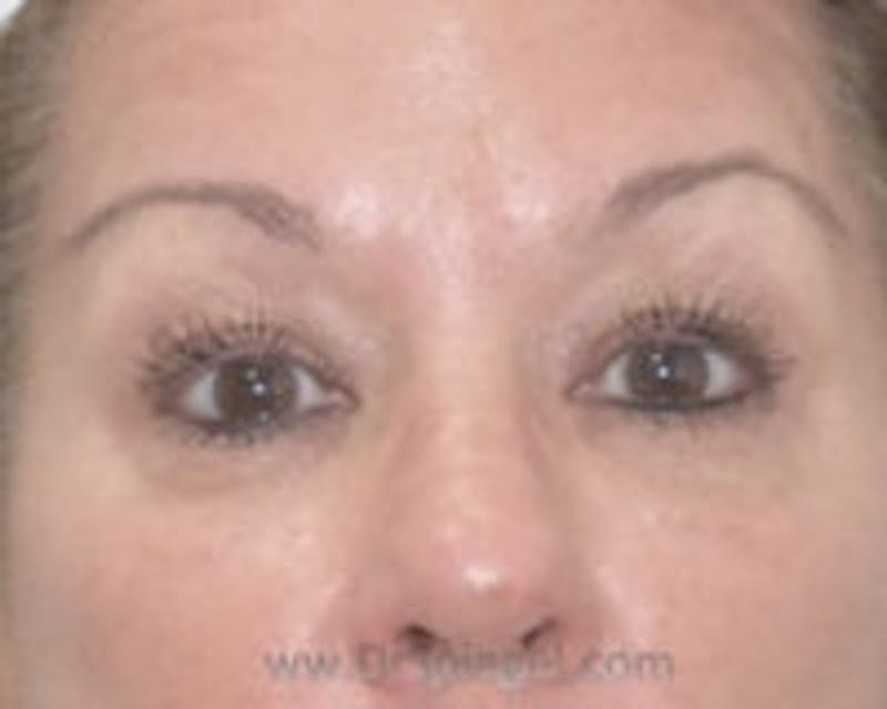 Tear Trough / Under Eye Fillers Before & After Gallery - Patient 218600 - Image 2