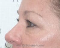 Tear Trough / Under Eye Fillers Before & After Gallery - Patient 218600 - Image 4