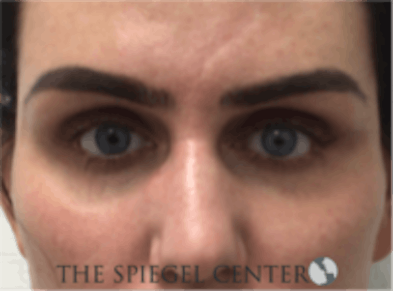 Tear Trough / Under Eye Fillers Before & After Gallery - Patient 273478 - Image 1