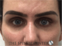 Tear Trough / Under Eye Fillers Before & After Gallery - Patient 273478 - Image 1