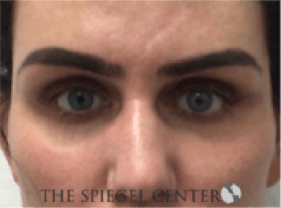 Tear Trough / Under Eye Fillers Before & After Gallery - Patient 273478 - Image 1