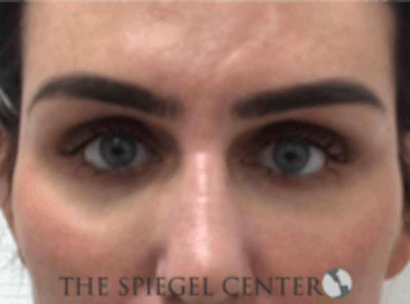Tear Trough / Under Eye Fillers Before & After Gallery - Patient 273478 - Image 2