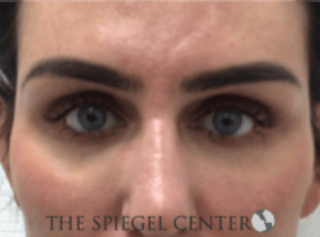 Tear Trough / Under Eye Fillers Before & After Gallery - Patient 273478 - Image 2