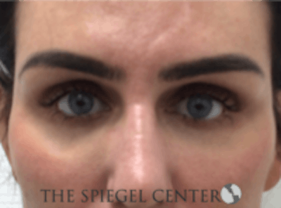 Tear Trough / Under Eye Fillers Before & After Gallery - Patient 273478 - Image 2