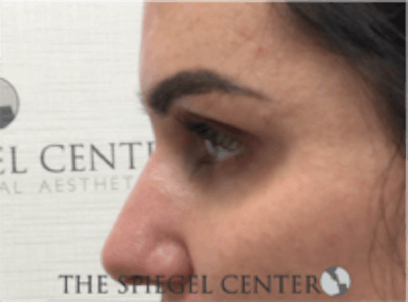 Tear Trough / Under Eye Fillers Before & After Gallery - Patient 273478 - Image 3