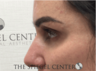 Tear Trough / Under Eye Fillers Before & After Gallery - Patient 273478 - Image 3