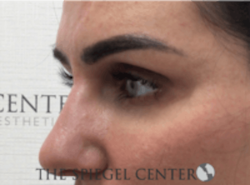 Tear Trough / Under Eye Fillers Before & After Gallery - Patient 273478 - Image 4