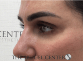 Tear Trough / Under Eye Fillers Before & After Gallery - Patient 273478 - Image 4