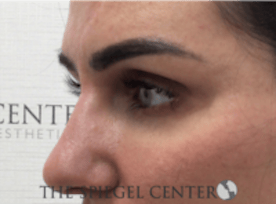 Tear Trough / Under Eye Fillers Before & After Gallery - Patient 273478 - Image 4