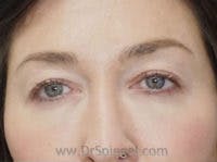 Tear Trough / Under Eye Fillers Before & After Gallery - Patient 210997 - Image 2