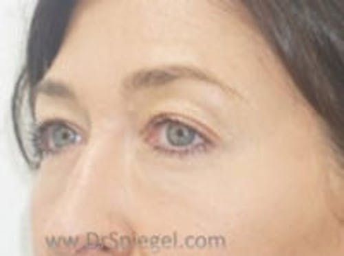Tear Trough / Under Eye Fillers Before & After Gallery - Patient 210997 - Image 3