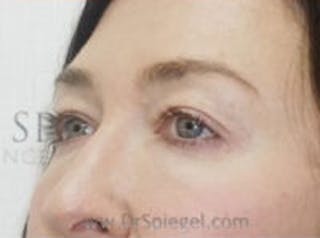 Tear Trough / Under Eye Fillers Before & After Gallery - Patient 210997 - Image 4