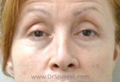 Tear Trough / Under Eye Fillers Before & After Gallery - Patient 221703 - Image 1