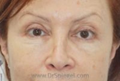 Tear Trough / Under Eye Fillers Before & After Gallery - Patient 221703 - Image 2
