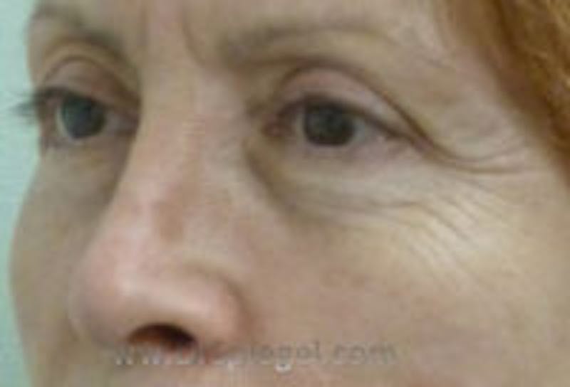 Tear Trough / Under Eye Fillers Before & After Gallery - Patient 221703 - Image 3