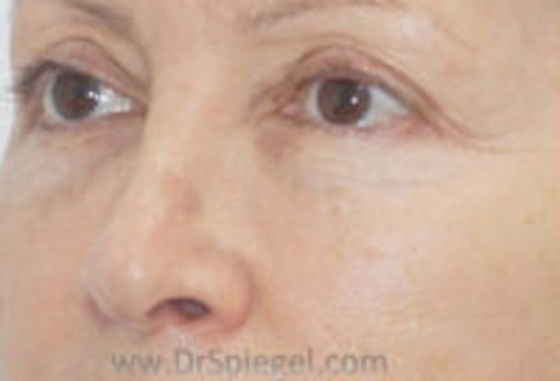Tear Trough / Under Eye Fillers Before & After Gallery - Patient 221703 - Image 4