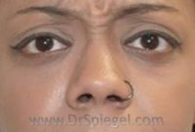 Tear Trough / Under Eye Fillers Before & After Gallery - Patient 293144 - Image 1