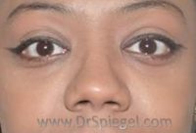 Tear Trough / Under Eye Fillers Before & After Gallery - Patient 293144 - Image 2