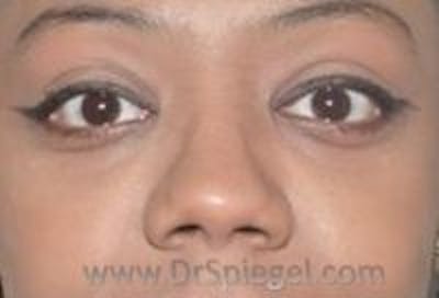 Tear Trough / Under Eye Fillers Before & After Gallery - Patient 293144 - Image 2