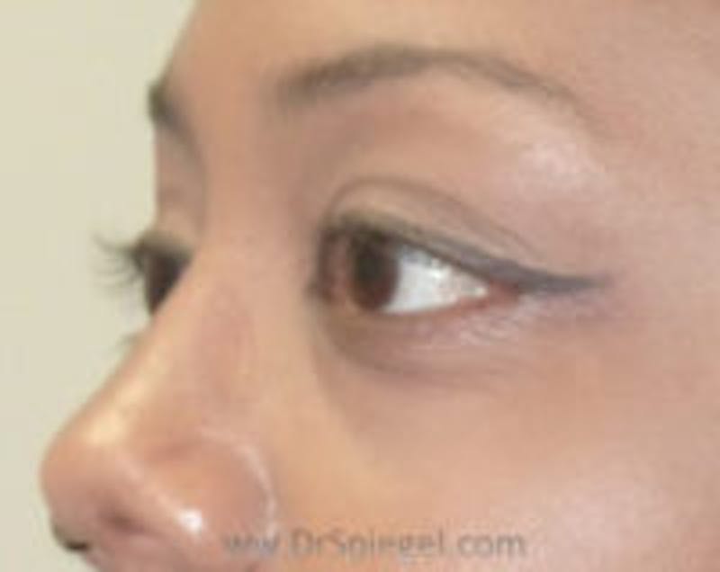 Tear Trough / Under Eye Fillers Before & After Gallery - Patient 293144 - Image 3