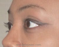 Tear Trough / Under Eye Fillers Before & After Gallery - Patient 293144 - Image 4