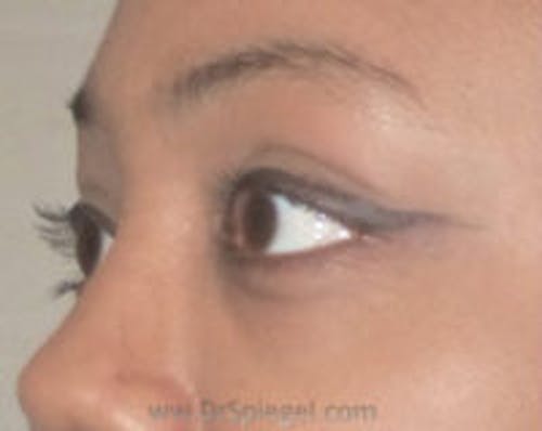 Tear Trough / Under Eye Fillers Before & After Gallery - Patient 293144 - Image 4