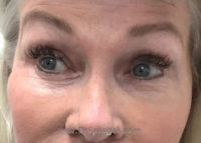 Tear Trough / Under Eye Fillers Before & After Gallery - Patient 350037 - Image 1