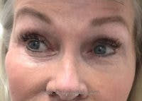 Tear Trough / Under Eye Fillers Before & After Gallery - Patient 350037 - Image 1