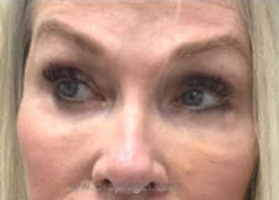 Tear Trough / Under Eye Fillers Before & After Gallery - Patient 350037 - Image 2