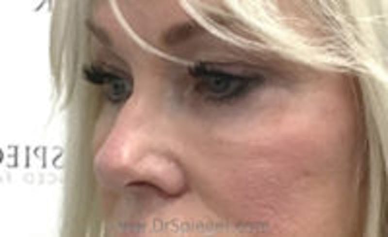 Tear Trough / Under Eye Fillers Before & After Gallery - Patient 350037 - Image 4