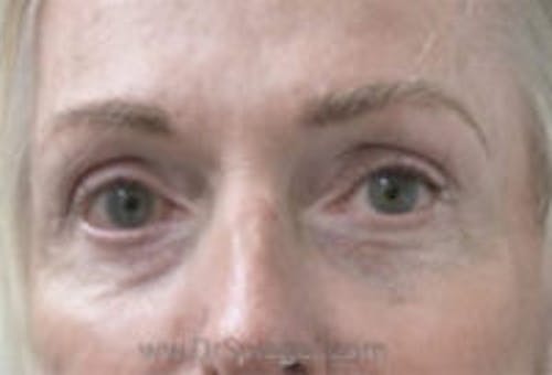 Tear Trough / Under Eye Fillers Before & After Gallery - Patient 242843 - Image 1
