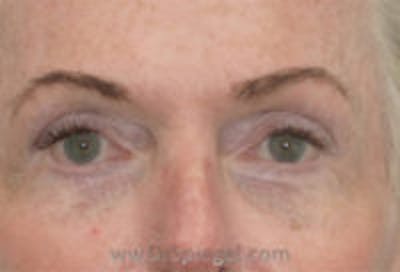 Tear Trough / Under Eye Fillers Before & After Gallery - Patient 242843 - Image 2