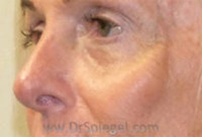 Tear Trough / Under Eye Fillers Before & After Gallery - Patient 242843 - Image 3
