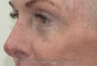 Tear Trough / Under Eye Fillers Before & After Gallery - Patient 242843 - Image 4