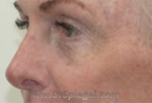 Tear Trough / Under Eye Fillers Before & After Gallery - Patient 242843 - Image 4