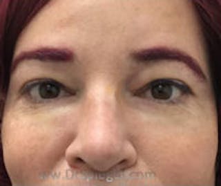 Tear Trough / Under Eye Fillers Before & After Gallery - Patient 249677 - Image 2