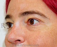 Tear Trough / Under Eye Fillers Before & After Gallery - Patient 249677 - Image 3