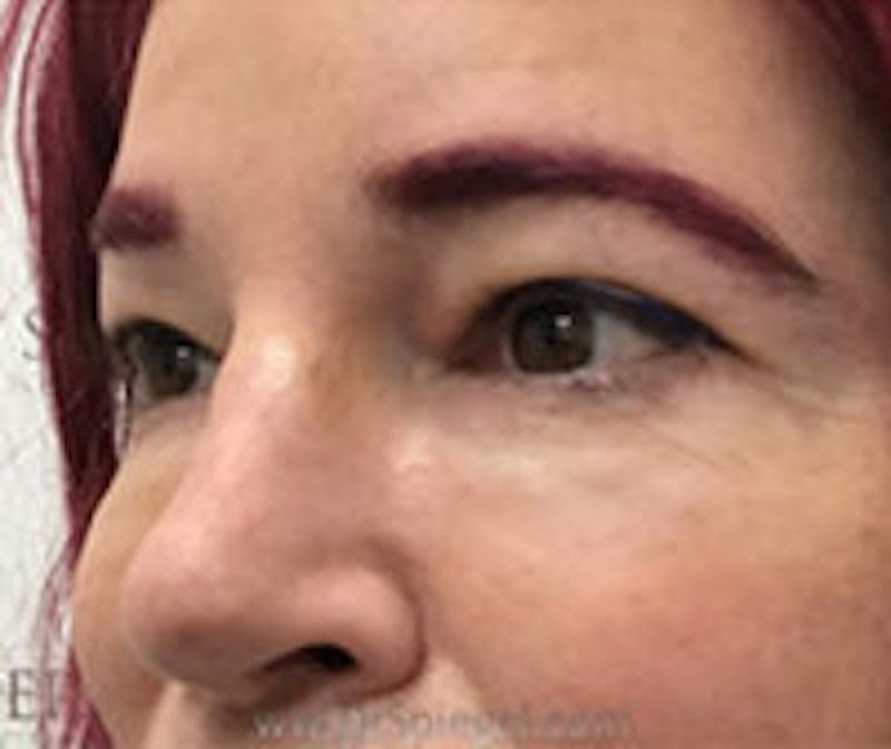 Tear Trough / Under Eye Fillers Before & After Gallery - Patient 249677 - Image 4