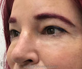 Tear Trough / Under Eye Fillers Before & After Gallery - Patient 249677 - Image 4