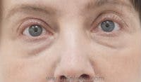 Tear Trough / Under Eye Fillers Before & After Gallery - Patient 333031 - Image 1