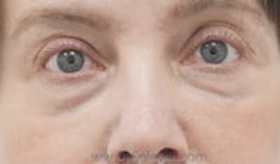 Tear Trough / Under Eye Fillers Before & After Gallery - Patient 333031 - Image 1